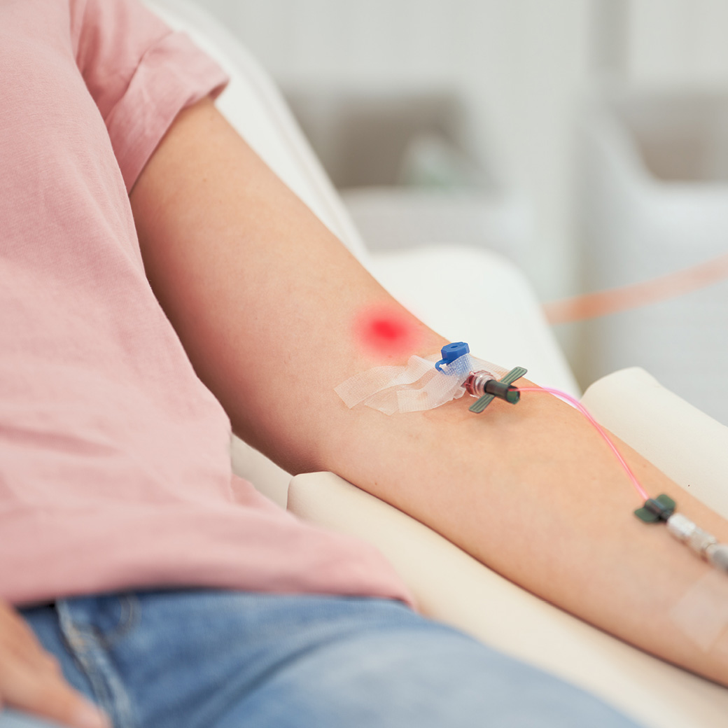 ILIB低能量靜脈雷射治療